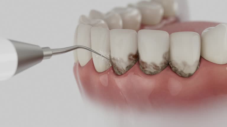 Trusted Wisdom Tooth Removal service in Astoria, OR - Dentist Open Now